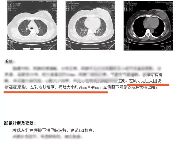 她选择按摩消除身体发现的肿块，结果一年后就崩溃了